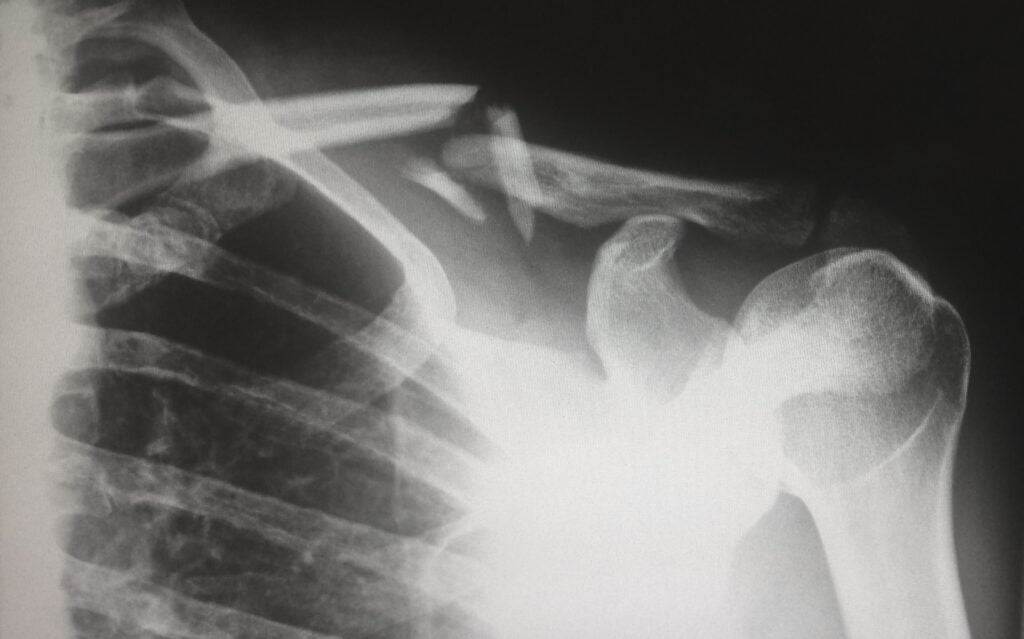 vitamin D, bone health